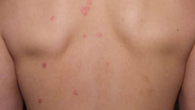 Understanding psoriasis symptoms and effects on skin health in individuals experiencing flare ups