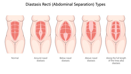 diastasis recti, including around-navel, below-navel, above-navel, and full-length abdominal separations diagram hand drawn schematic vector illustration. Medical science educational illustration