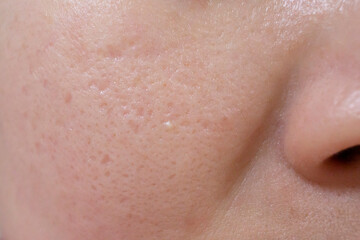 팔자주름과 볼 모공