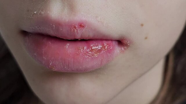 Infectious disease herpes simplex virus cells