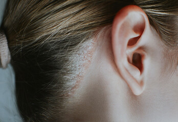 Psoriasis on a woman's head close-up with redness and peeling