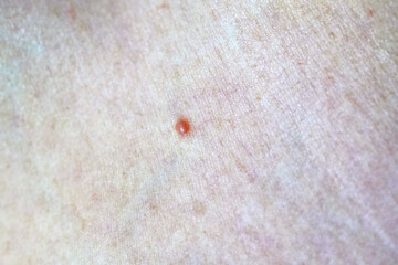 Folliculitis on human chest treatment.