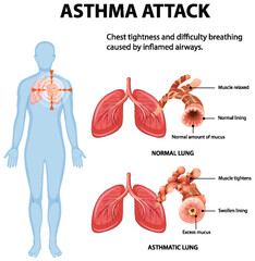 Understanding Asthma and Lung Function