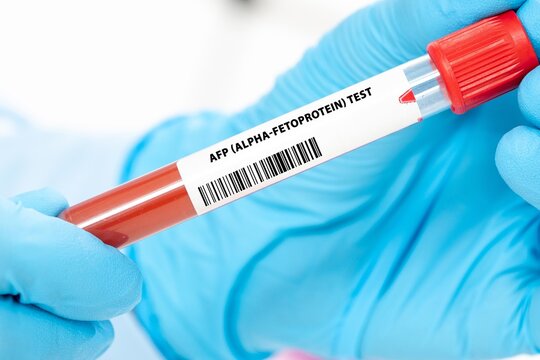 AFP (Alpha-Fetoprotein) Test