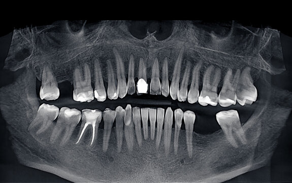 Panoramic x-ray of human teeth. Human jaw and teeth through x-ray