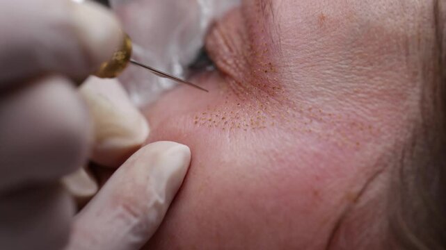 Beautician applying plasma penBeautician applying plasma pen