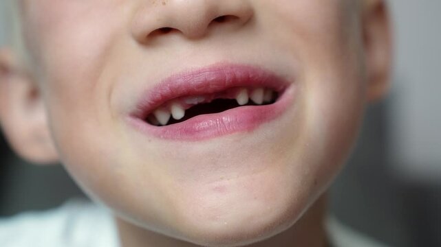 Close-up of a boy's smile with missing front teeth. Concept pediatric dentistry, baby teeth change, tooth loss. 