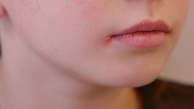 Portrait of a little girl with herpes inflammation on her lips, a viral disease. He squeezes and bites his lips, looks away. Itching.