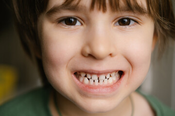 Close-up headshot of little preschool cute boy widely smiling, showing the first baby milk teeth. Happy four or five years old small adorable cutie toddler with primary teeth. Portrait. 