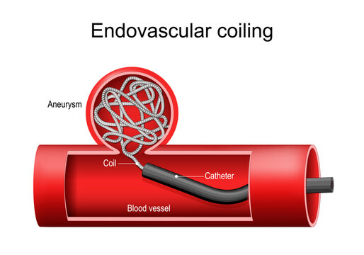 Endovascular coiling of aneurysm