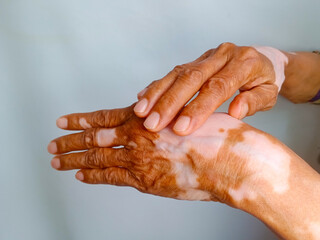 Fototapeta premium Close up of Old woman hands with skin problem called Vitiligo, isolated on white background