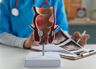 Doctor with model of human anatomy of rectum and hemorrhoids in hospital