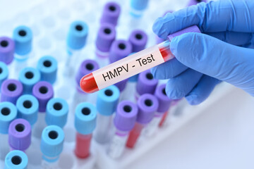Naklejka premium Doctor holding a test blood sample tube with Human metapneumovirus virus test on the background of medical test tubes with analyzes. Human Metapneumovirus, HMPV virus.