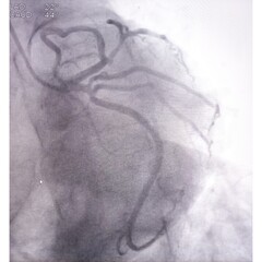 Coronary angiogram of left coronary artery during cardiac catheterization with contrast dye....