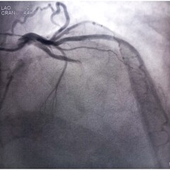 Coronary angiogram of left coronary artery during cardiac catheterization with contrast dye. Abnormal findings. Colour adjust.
