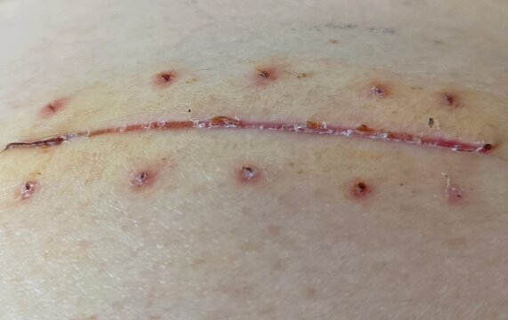 Close up of appendectomy wound