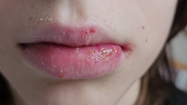 Tongue and lips and infectious disease herpes simplex virus cells
