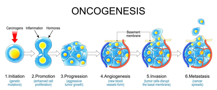Carcinogenesis. Oncogenesis stages. Cancer development