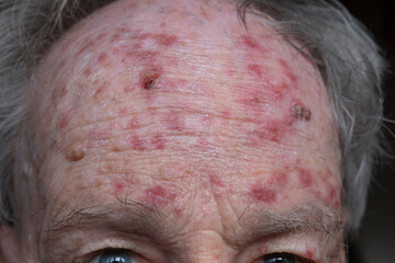 Forehead of man during treatment for actinic keratosis with Flurouracil ointment. Red crusty lesions of sun-damaged skin or sunspots