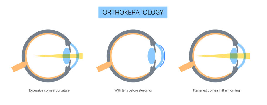 Orthokeratology contact lens