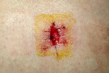 Partially dissolved suture after removal of surgical sutures during surgery to excise a mole on the...