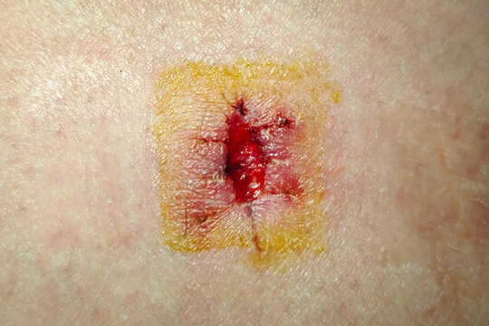 Partially dissolved suture after removal of surgical sutures during surgery to excise a mole on the thigh. Iodine, blood, sputum, stitch marks on the skin, sore, clotted blood.