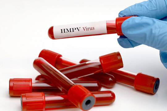 Doctor's hand in hospital showing blood sample tube for HMPV virus analysis test in clinical laboratory.