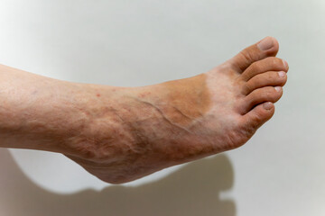 Fototapeta premium Visible veins on a foot with uneven skin tone in natural lighting