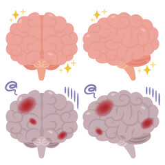 健康でキレイな脳と炎症が起きた不健康な脳のイラスト