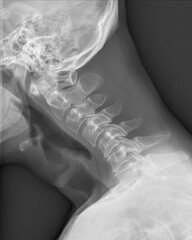 X-ray of the human cervical spine. Early degenerative change at cervical spine. Cervical disc...