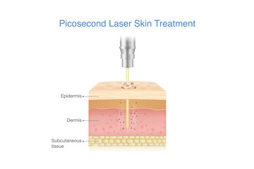 Reduce Melasma, freckles, blemishes, wrinkles and spots by Picosecond Laser breaks down pigmentation in skin layer into smaller fragments. Medical laser called Pico.