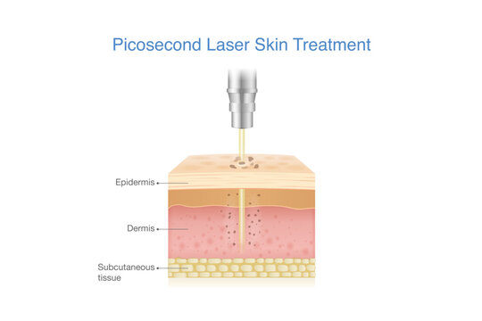 Reduce Melasma, freckles, blemishes, wrinkles and spots by Picosecond Laser breaks down pigmentation in skin layer into smaller fragments. Medical laser called Pico.