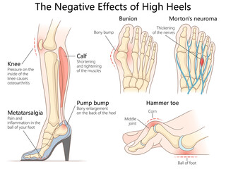 health issues caused by high heels, including bunions, hammer toe, knee pain, and calf muscle strain diagram hand drawn schematic raster illustration. Medical science educational illustration © Oleksandr Pokusai