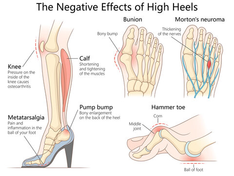 health issues caused by high heels, including bunions, hammer toe, knee pain, and calf muscle strain diagram hand drawn schematic raster illustration. Medical science educational illustration
