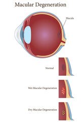 illustration of macular degeneration, dry and wet macular. vector eps 10
