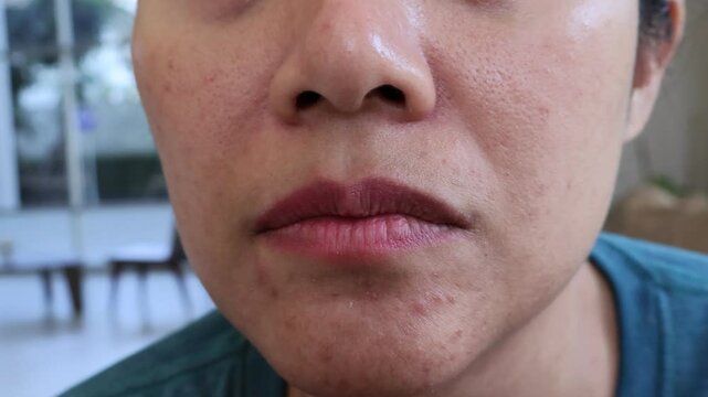 Close Up Asian woman face with acne inflamed on her face. haggard face. Under-eye bags, Tear trough deformity, Dark circles under the eyes