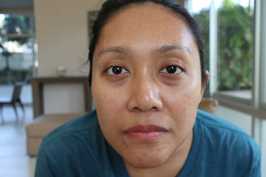 Close Up Asian woman face with acne inflamed on her face. haggard face. Under-eye bags, Tear trough deformity, Dark circles under the eyes