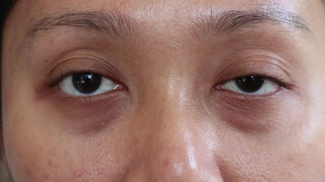 young woman face has dark bags under her eyes. Swelling of the lower eyelid and deep. Unhealthy appearance