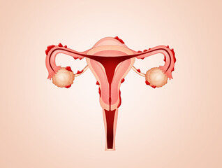 illustration of uterus with endometriosis
