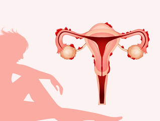 illustration of endometriosis disease