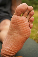 The bare foot shows traces of needles from under a board with nails. A close-up of a bare foot on a...