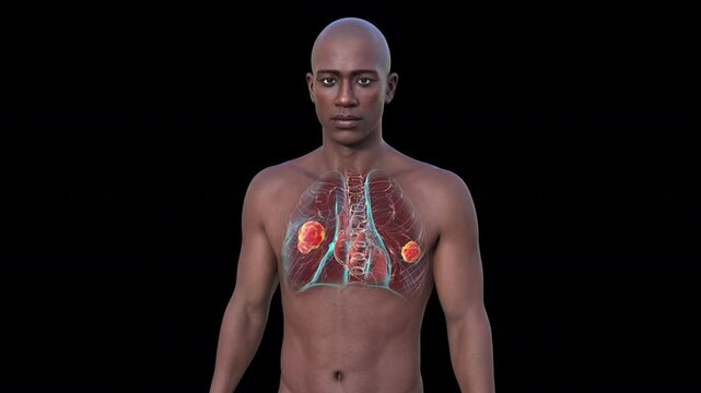 Lung mucormycosis, 3D animation showing fungal infection caused by Mucorales fungi, highlighting multiple irregular lung nodules.
