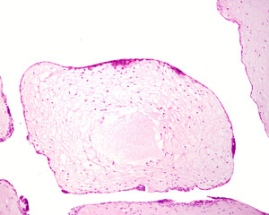 Hydatidiform mole