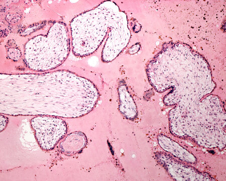 Human placenta. Mole of Breus