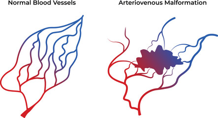 Normal Blood Vessels Arteriovenous Malformation Science Design Vector Illustration Diagram