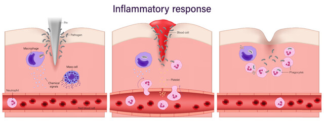 Inflammatory response. Process of inflammation. phagocytosis. Blood clotting.