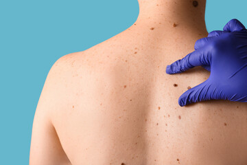 Dermatologist examining moles on woman's back against blue background, closeup