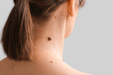 Woman with moles on her neck against light background, back view