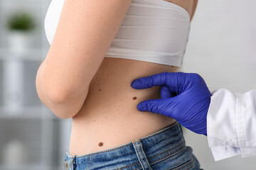 Dermatologist examining moles on woman's belly in clinic, closeup