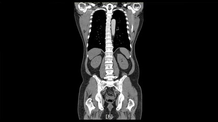 x-ray scan of front body by mri ct scan Internal Organs and Liver,Lungs,Intestines,Stomach,Bladder,Kidneys.